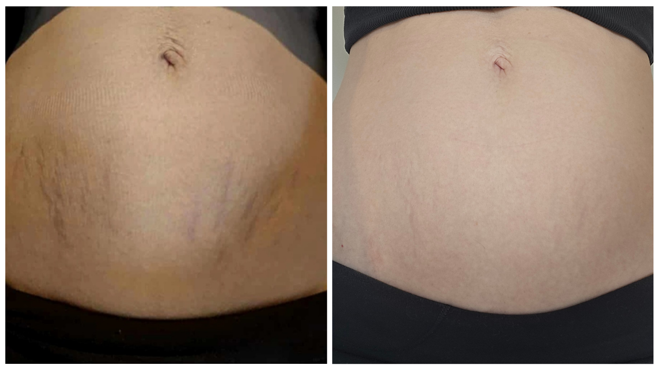 Before and after comparison of a person's abdomen with stretch marks scars.