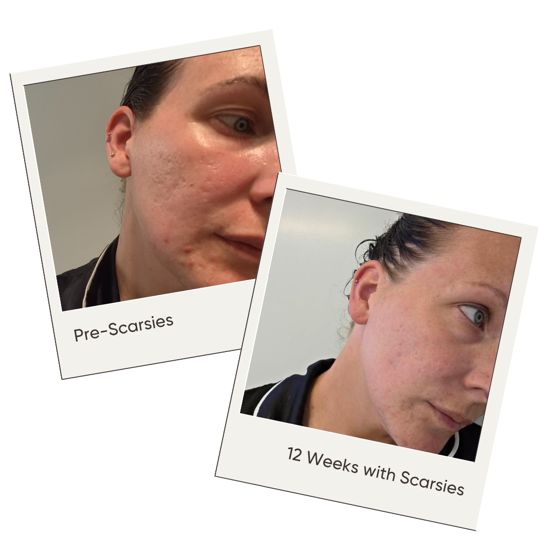 Before and after comparison of a person's facial acne scarring with text indicating 'Pre-Scarsies' and '12 Weeks with Scarsies'.