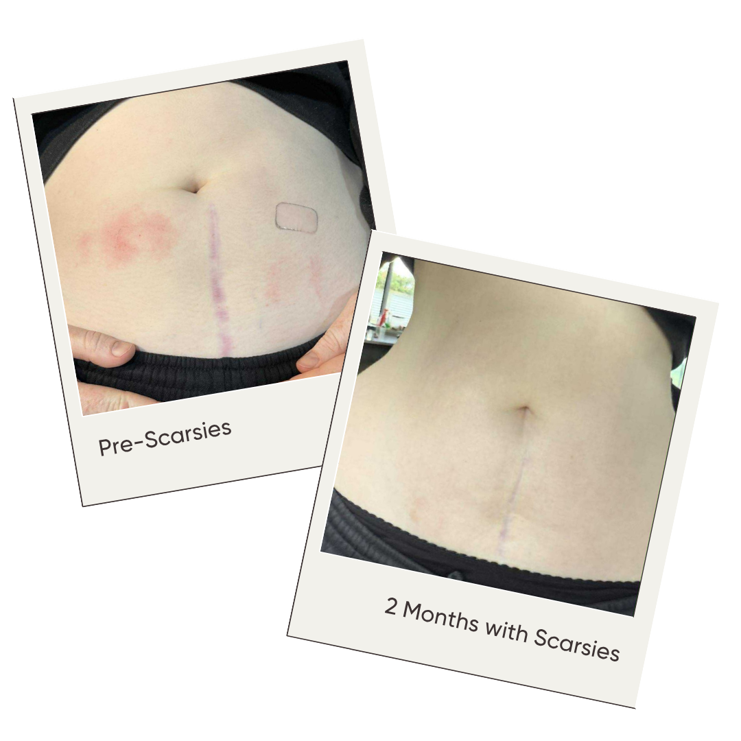 Before and after comparison of scars with 'Pre-Scaries' and '2 Months with Scaries' labels.