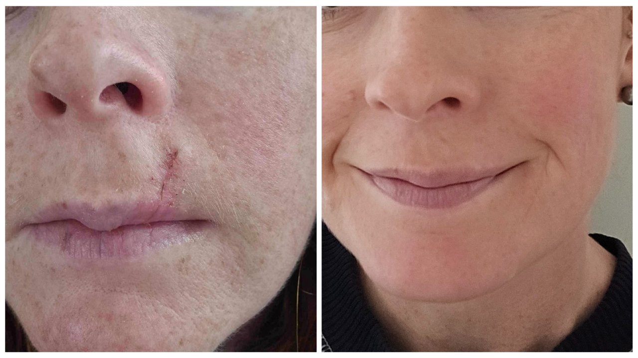 Before and after comparison of a person's face with visible scar on the left, and smoother skin on the right.