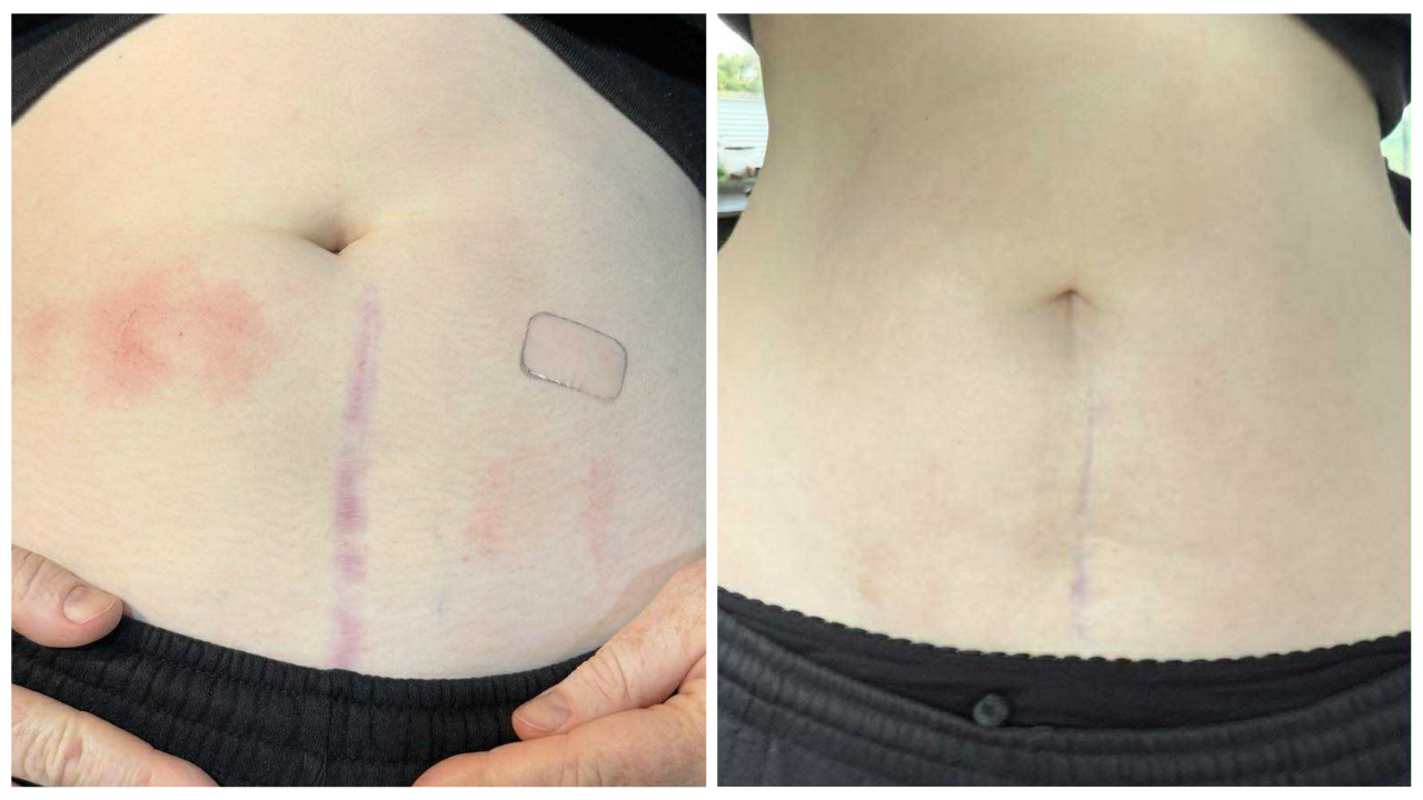 Before and after comparison of a surgical scar on a person's abdomen.