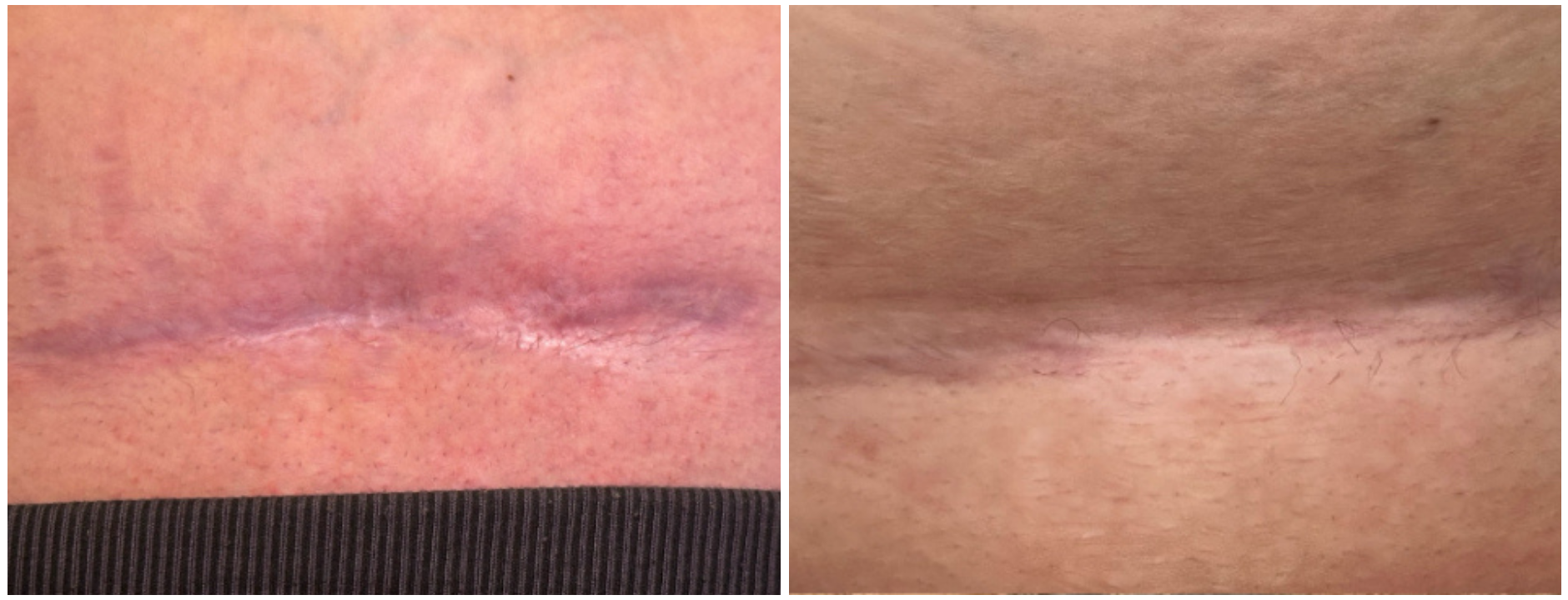 Before and after comparison of skin texture on a person's C-section scar.