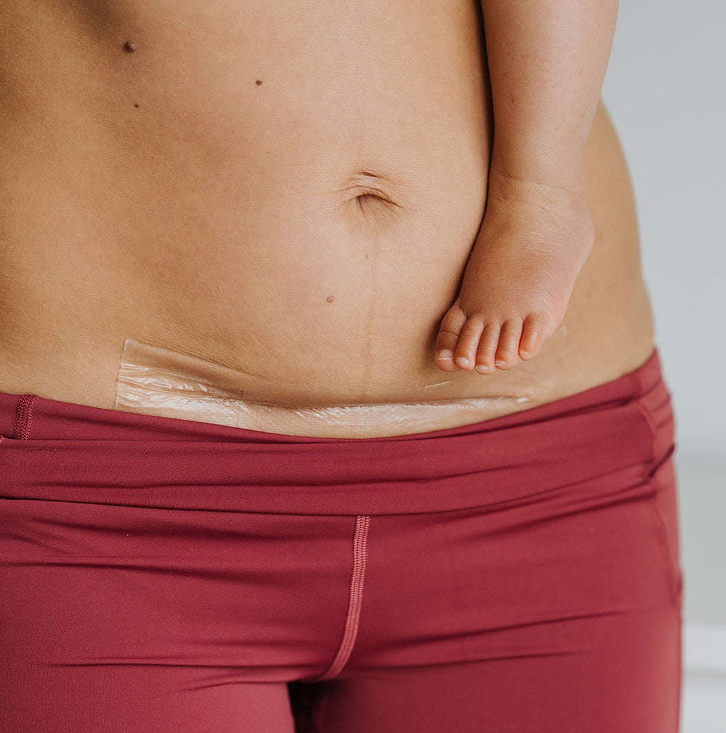 Scarsies Silicone Scar Tape